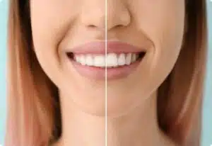 5 Foods That Are Destroying Your Teeth