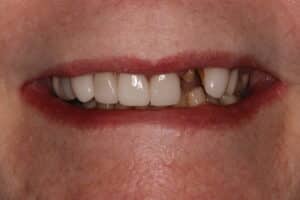 What to Do if Your Tooth Breaks (Do This Immediately)”